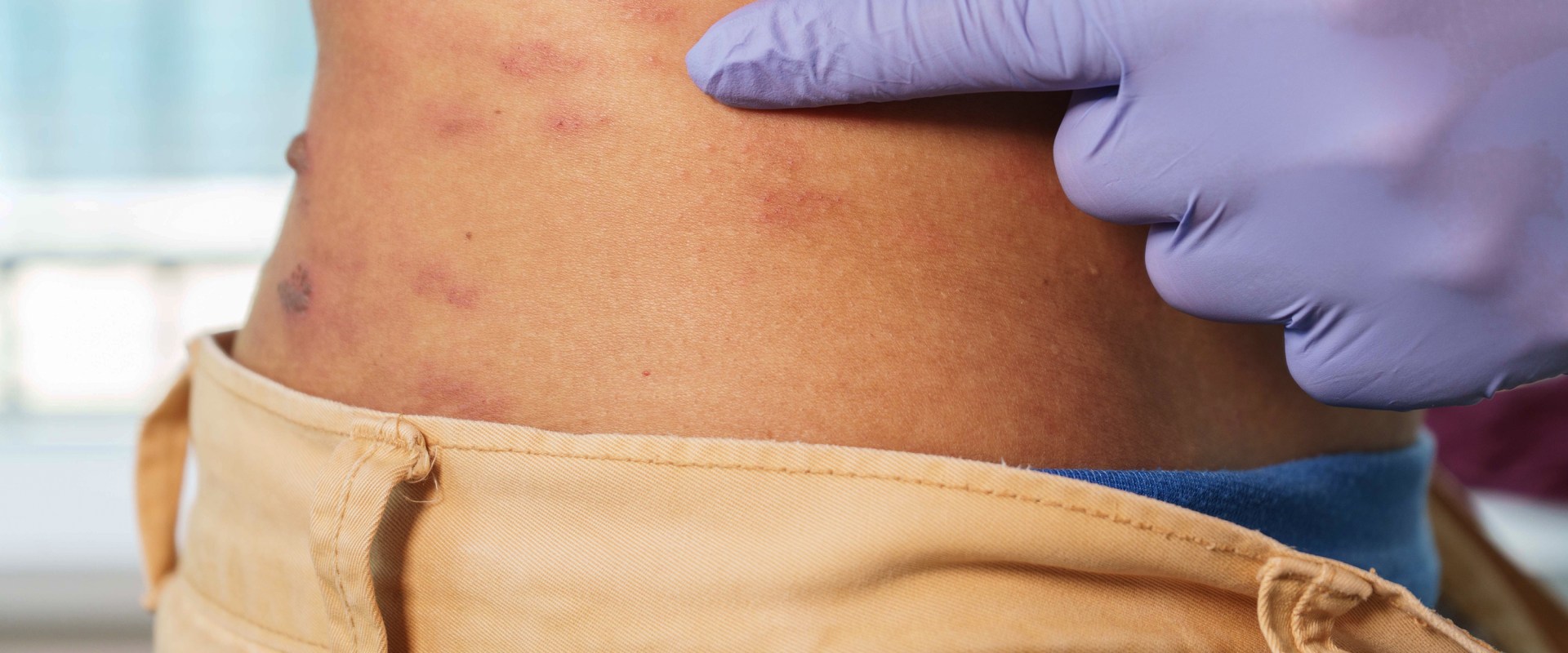 Alternative Therapies for Managing PHN Pain