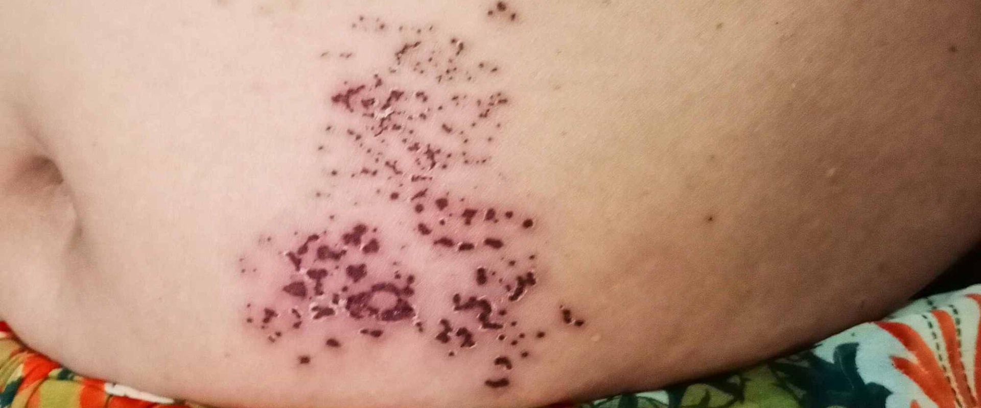Tips for Reducing the Risk of VZV Infection