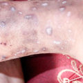 Understanding Skin Infections and How to Treat Them