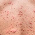 Antiviral Drugs: Exploring Treatments for Zoster Herpes