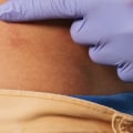 Alternative Therapies for Managing PHN Pain