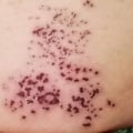 Tips for Reducing the Risk of VZV Infection