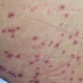 Antiviral Medications for VZV Infection: A Comprehensive Overview