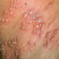 Boosting the Immune System with Diet and Exercise: A Guide to Prevention of Zoster Herpes