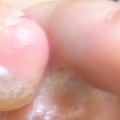 Blisters: What You Need to Know