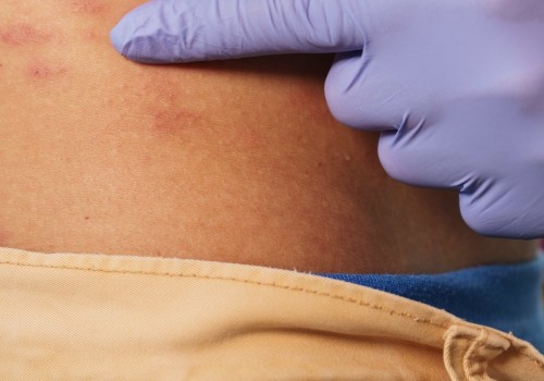 Alternative Therapies for Managing PHN Pain