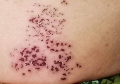 Tips for Reducing the Risk of VZV Infection