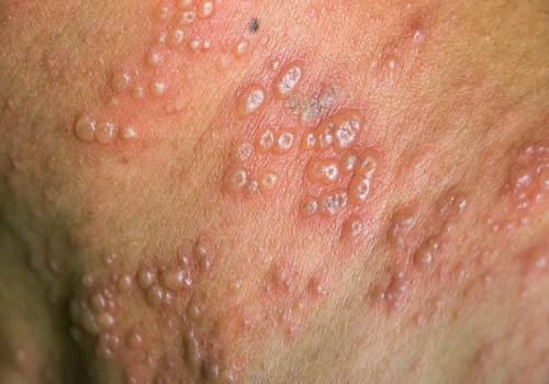 Boosting the Immune System with Diet and Exercise: A Guide to Prevention of Zoster Herpes